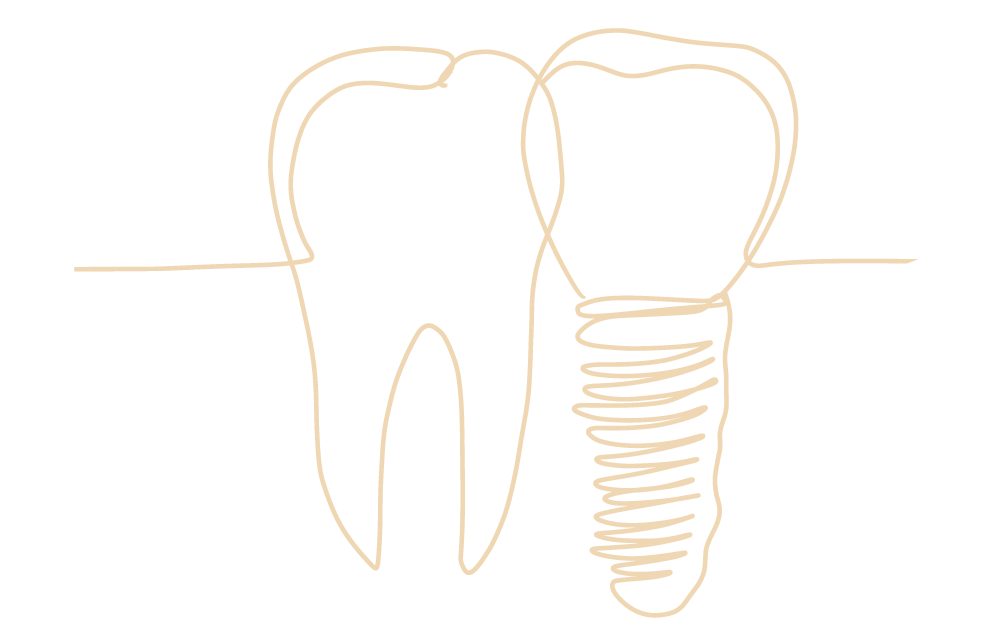 Eine feine, reduzierte Zeichnung eines Zahnimplantats als Metapher für den Schwerpunkt Implantate in der Praxis am Mexikoplatz in Berlin