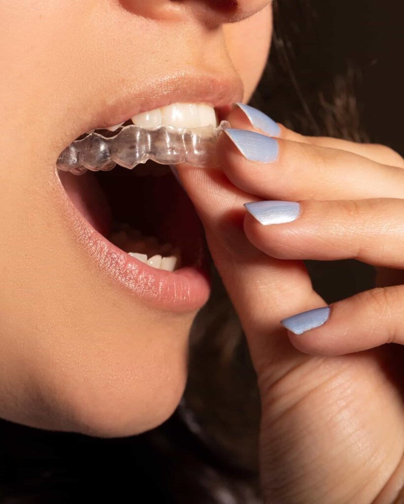 Die Hände einer Frau führen eine durchsichtige Zahnschiene in den Mund ein